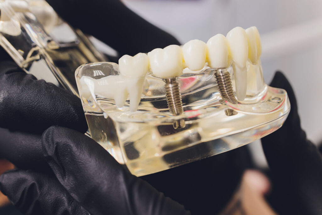 implantologia-dental