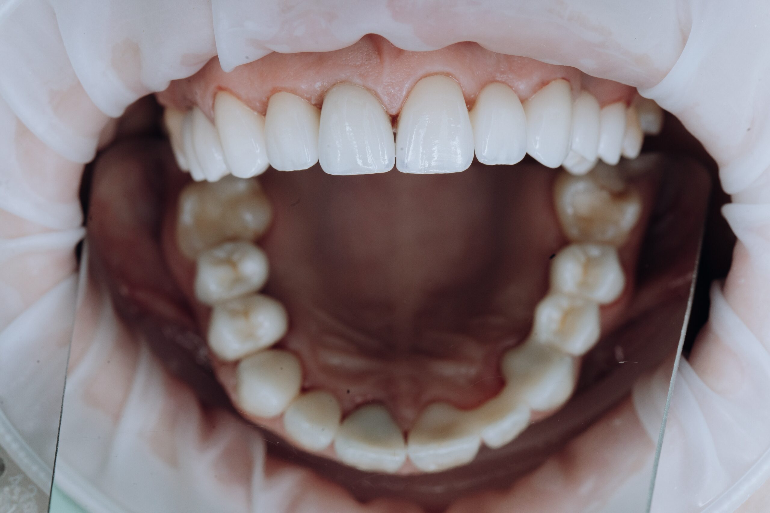 carillas-dentales-perfectas